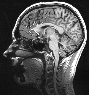 MRI Sagittal 