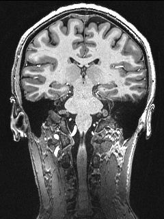 MRI Coronal